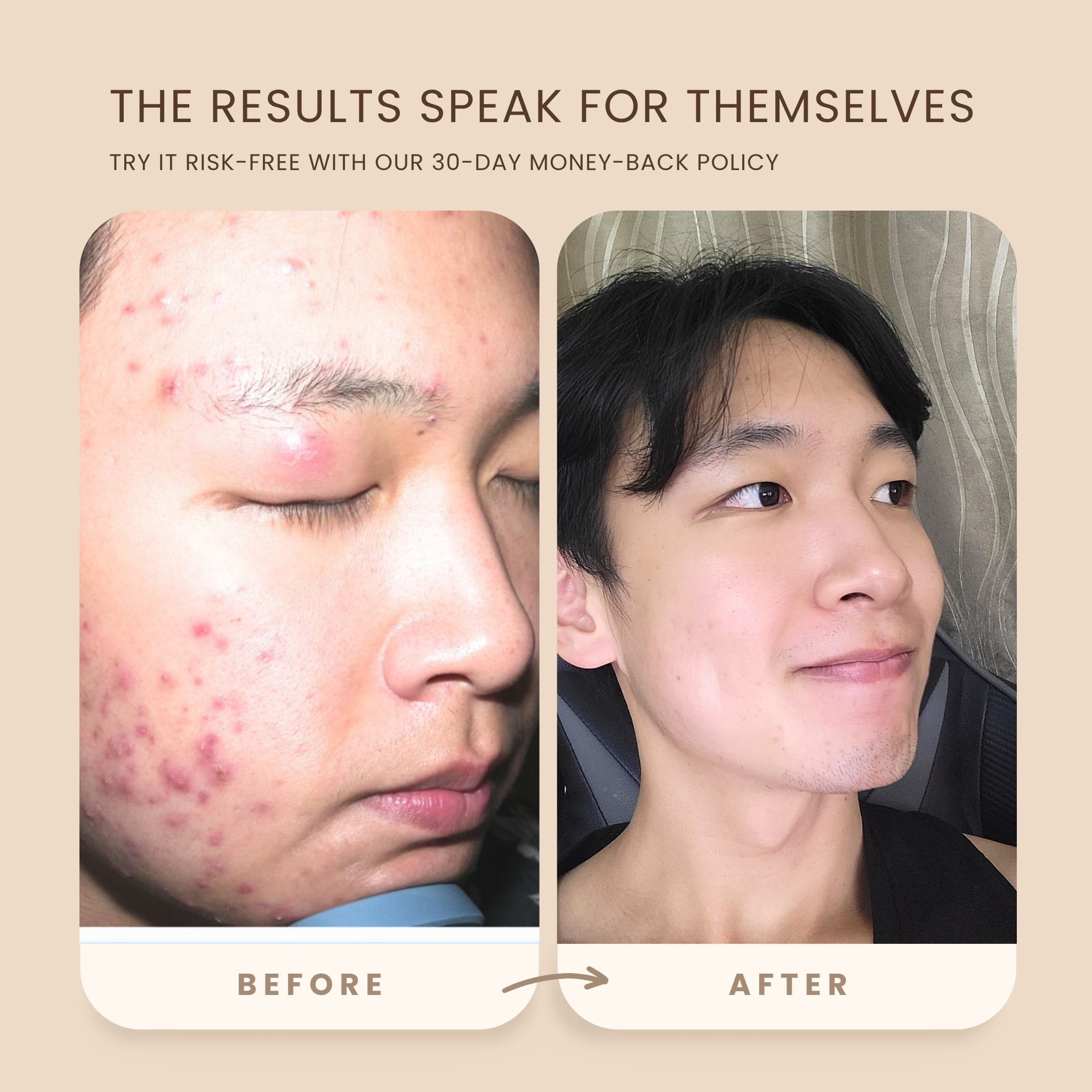 Anti-Acne/Blemish + FREE Facial (Bundle)