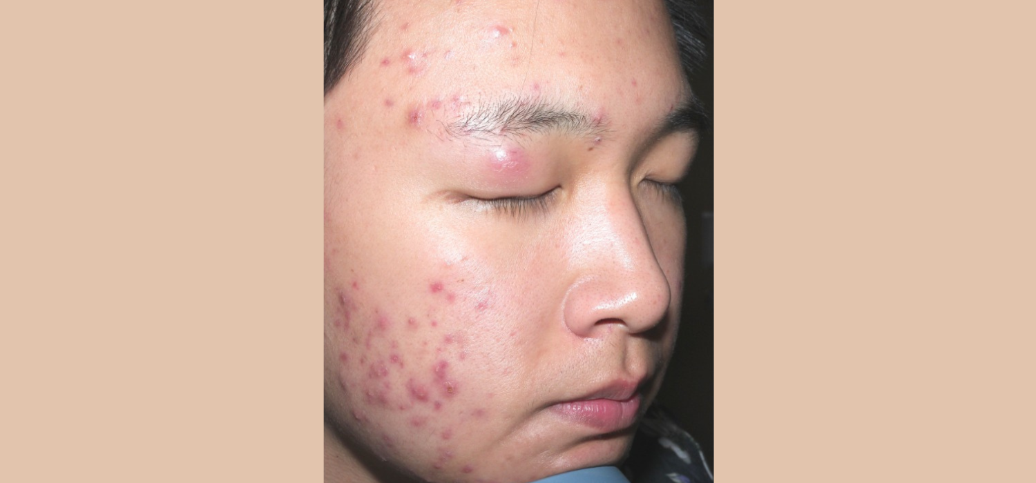 Acne-Before-Image